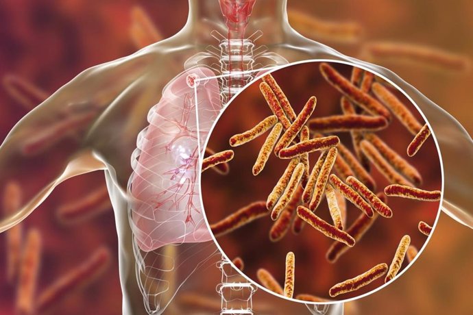 Archivo - Arquivo - Tuberculose