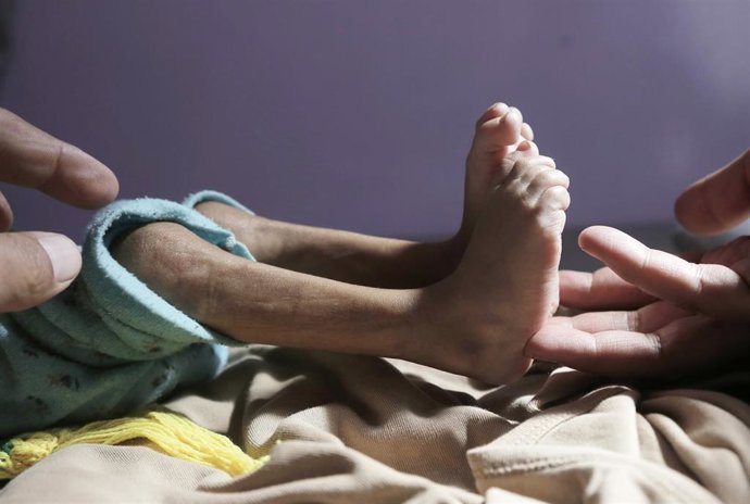 Archivo - Imagen de archivo de un niño con desnutrición en un hospital en Yemen
