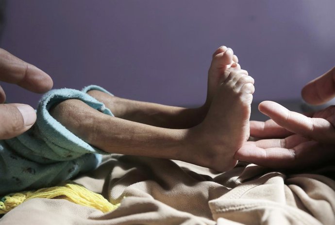 Archivo - BEIJING, Dec. 17, 2024 -- Uma criança desnutrida é tratada em um hospital em Sanaa, Iêmen, em 14 de dezembro de 2024. A guerra civil, que começou no final de 2014 entre o grupo Houthi e o governo do Iêmen, já causou centenas de milhares de morte