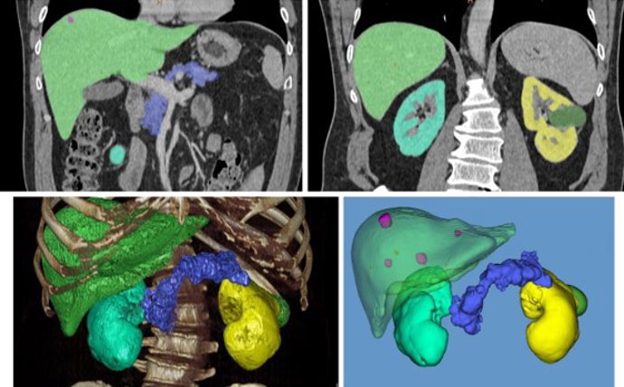 Imágenes de TAC mostrando diferentes órganos abdominales y lesiones potencialmente tumorales en el hígado