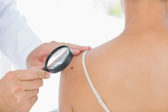 Archivo - Arquivo - Moles, câncer de pele, melanoma