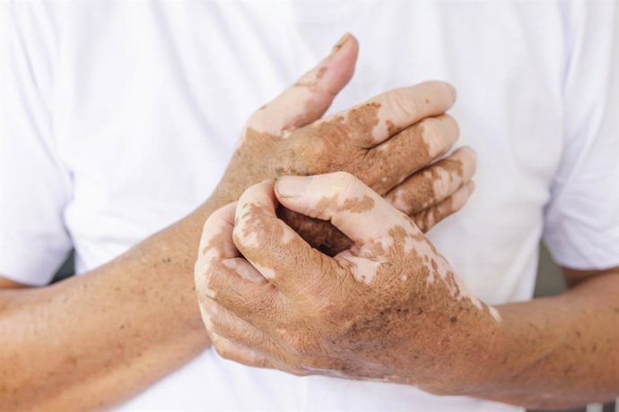 Archivo - Arquivo - Despigmentação nas mãos como consequência do vitiligo
