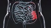 Foto: Colibactina, la bacteria que podría estar tras el aumento del cáncer colorrectal en menores de 50 años