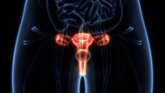 Foto: La extirpación de ovarios reduce el riesgo de cáncer y mejora la supervivencia en mujeres con BRCA1 y BRCA2