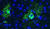 Foto: La acumulación excesiva de una proteína en el cerebro actúa como "motor activo" del Alzheimer en etapas tempranas