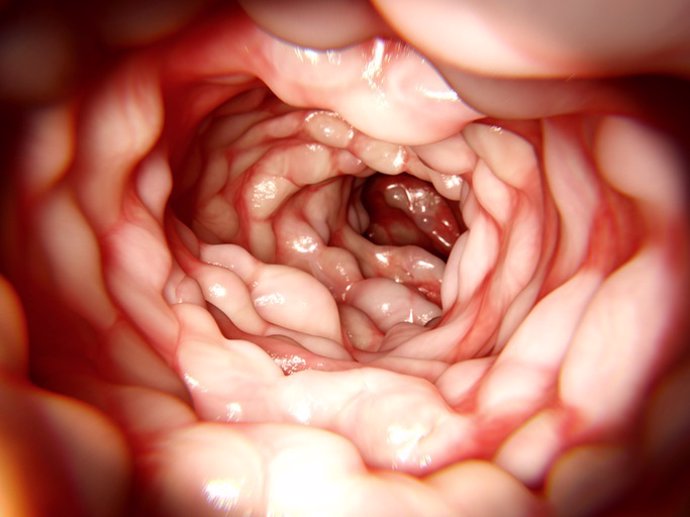 Archivo - Imagen de recurso de un intestino afectado por la enfermedad de Crohn.