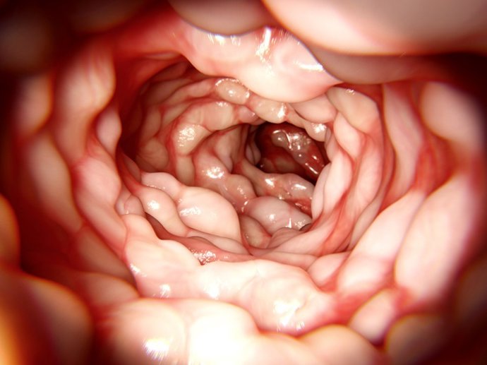 Archivo - Intestino afetado por Morbus Crohn