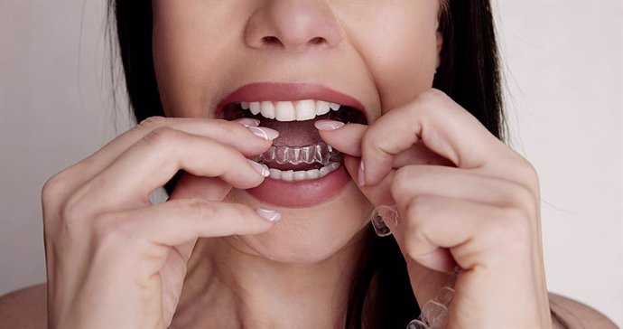 Archivo - Imagen de recurso de un alineador dental transparente.