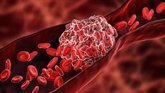 Foto: Un radiólogo vascular destaca la importancia del diagnóstico precoz de la trombosis venosa profunda