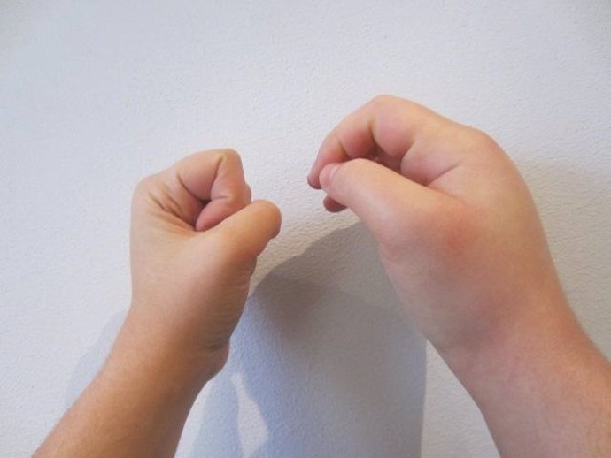 Archivo - Hinchazón en una mano causada por angioedema hereditario.