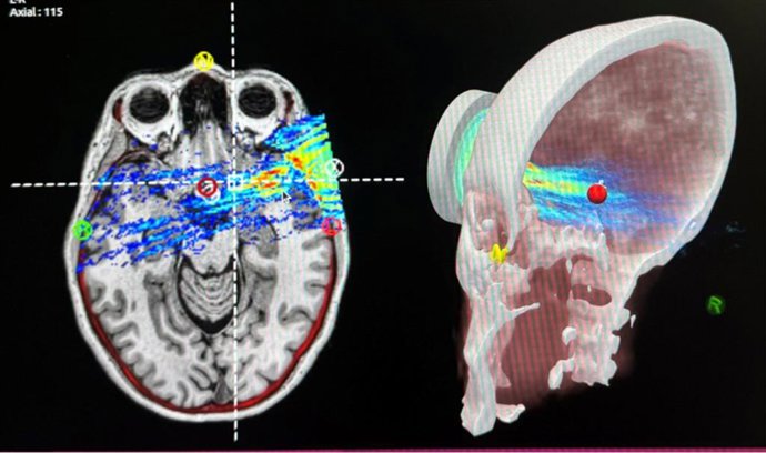 Focused Ultrasound can target specific areas of the brain allowing enhanced exosome uptake.