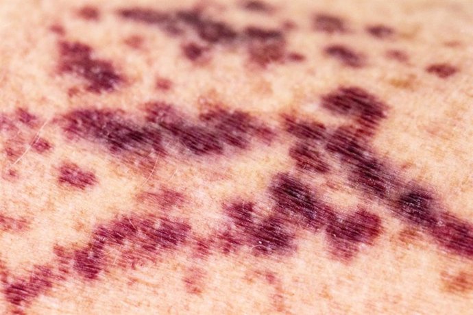 Archivo - Imagen de recurso de vasculitis.