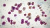 Foto: Nuevos marcadores metabólicos en líquido cefalorraquídeo predicen mortalidad en meningitis tuberculosa