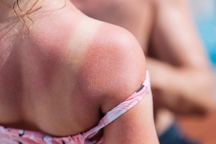 Archivo - Arquivo - Sunburn.
