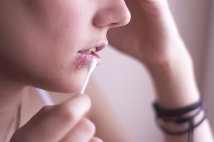 Archivo - Herpes en el labio.