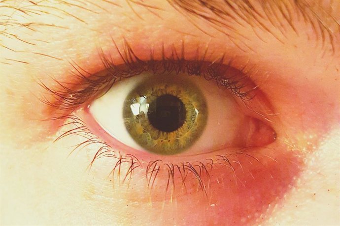 Archivo - Retinoblastoma