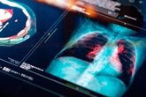 Foto: El metotrexato es tan eficaz como la prednisona en la sarcoidosis pulmonar