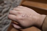 Foto: Australia notifica su primer caso de mpox por clado Ib en un paciente que viajó a Tailandia