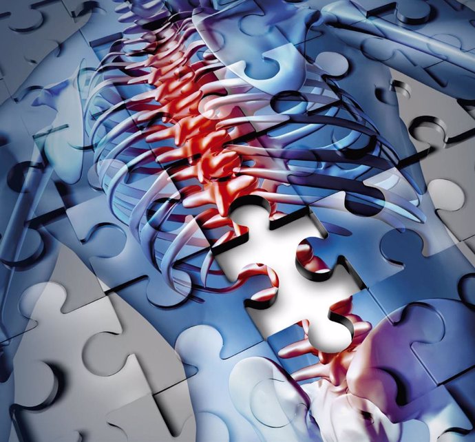 Estenosis de canal lumbar.