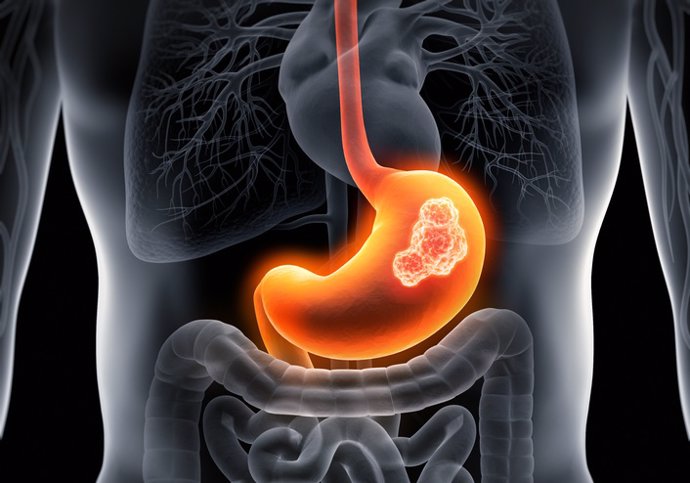 Archivo - Imagen de recurso de un cáncer de estómago.