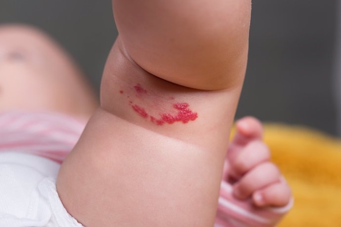Archivo - Hemangioma infantil.