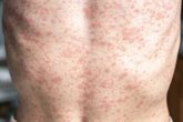 Foto: La Sociedad Española de Epidemiología anima a vacunarse contra al sarampión frente al "goteo continuo" de casos