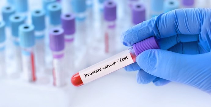 Una uróloga advierte de que el dolor óseo en hombres mayores es una "señal silenciosa" de cáncer de próstata metastásico
