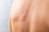 Foto: La Sociedad Española de Reumatología insta a financiar la vacunación de personas con lupus contra el herpes zóster