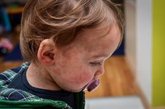 Foto: Por qué es tan importante que los niños se vacunen frente al sarampión: esto dicen los expertos