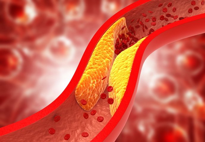 Archivo - Imagen de recurso de colesterol.