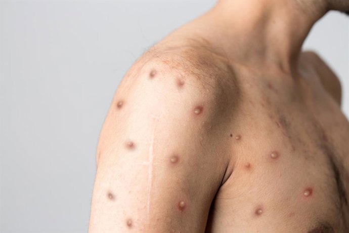 Archivo - Arquivo - Monkeypox.