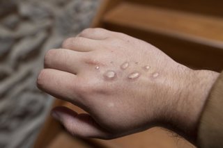 Archivo - Imagen de recurso de una persona con mpox.