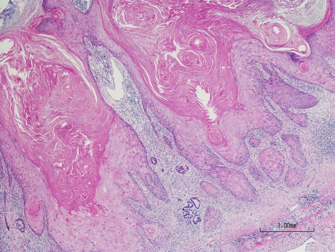Archivo - Arquivo - Micrografia de carcinoma de células escamosas da pele.