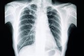 Foto: Un modelo de IA que detecta la enfermedad del hígado graso con radiografías de tórax