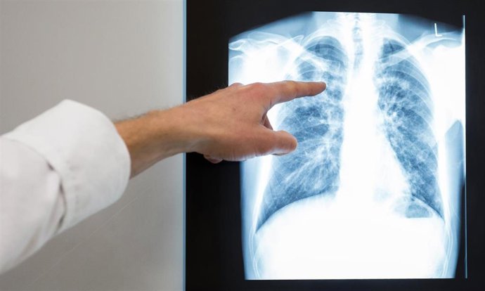 Archivo - FILED - 02 March 2017, Berlin: A doctor points to a lung X-ray at Vivantes Neukoelln Hospital. Hepatitis, HIV, tuberculosis (TB) and sexually transmitted infections such as syphilis and gonorrhoea continue to pose significant challenges for heal