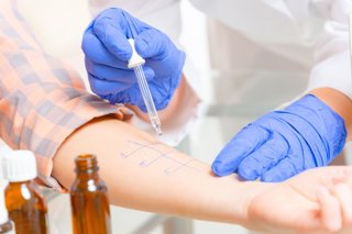 Archivo - Pruebas de alergia.