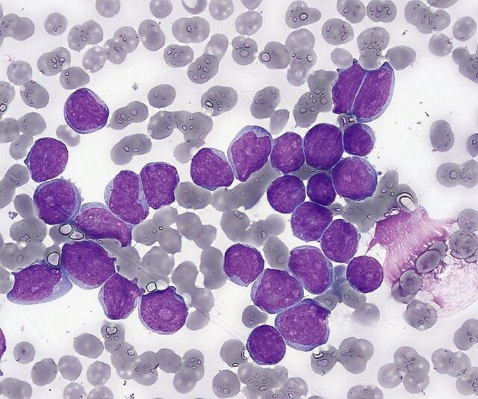 Leucemia linfoblástica aguda.