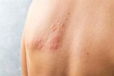 Foto: Virus del herpes modificado genéticamente ofrece una nueva esperanza en melanoma avanzado intratable