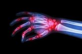Foto: Artritis Reumatoide: abren vías a su diagnóstico precoz tras hallar nuevas estructuras de la articulación de la mano
