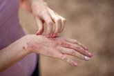 Foto: Dolor al cortar un tomate o al agarrar una botella: retos diarios de los pacientes con eccema crónico de manos grave