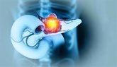 Foto: Una estrategia contra el cáncer de páncreas plantea combinar radioterapia con hipertermia generada por nanopartículas