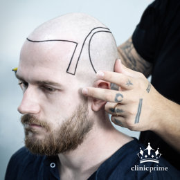 Breakup Blues Are Fuelling a Surge in Hair Transplant Travel, Says Clinic Prime