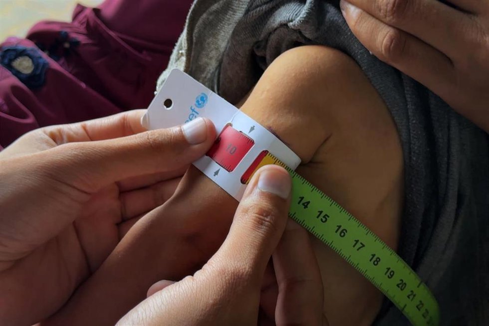 Pruebas a un niño palestino con desnutrición en una clínica de la Agencia de Naciones Unidas para los Refugiados de Palestina en Oriente Próximo (UNRWA) en la Franja de Gaza en medio de la ofensiva militar de Israel (archivo)