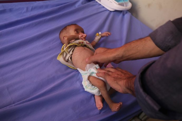 July 23, 2025, Gaza City, Gaza Strip, Palestinian Territory: Palestinian children suffering from malnutrition receive medical care at Al-Rantisi Children's Hospital in Gaza City, amid a severe shortage of food and medicine, further worsening the humanitar