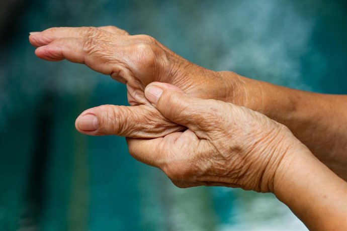 Archivo - Arquivo - Mãos de uma mulher com osteoartrite.