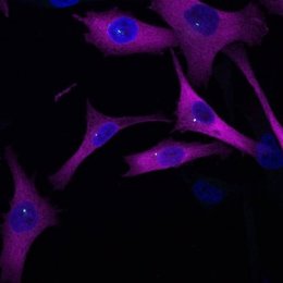 Células de melanoma