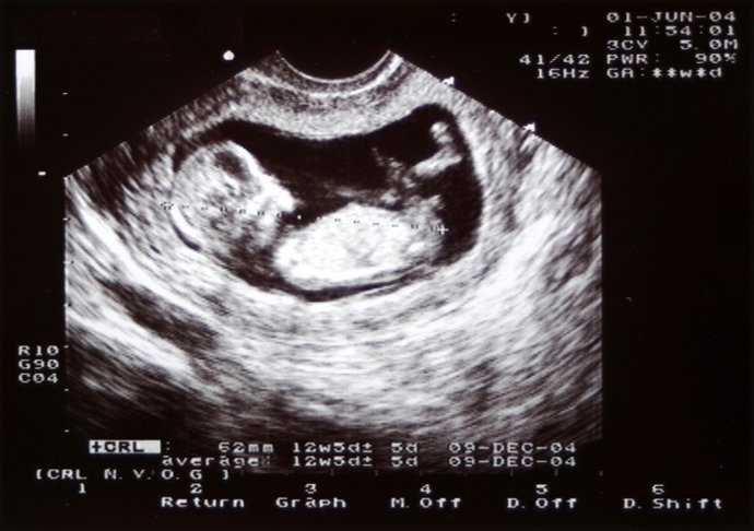 Archivo - Ultrasound, 12 weeks old