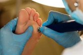 Foto: Las consultas por hongos en los pies aumentan hasta un 30% en los meses de julio y agosto