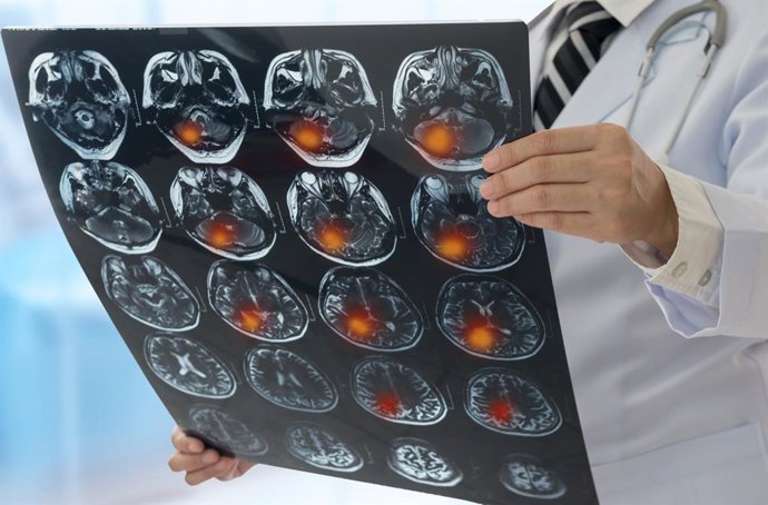 Archivo - Imagen de recurso de una exploración cerebral.