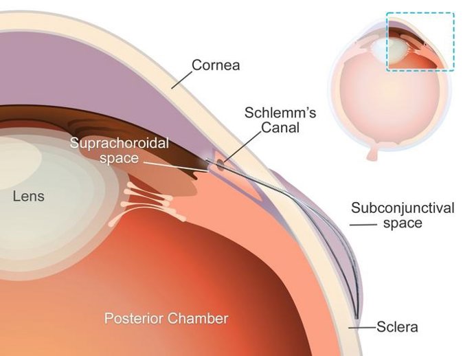 Imagen del 'microstent'.